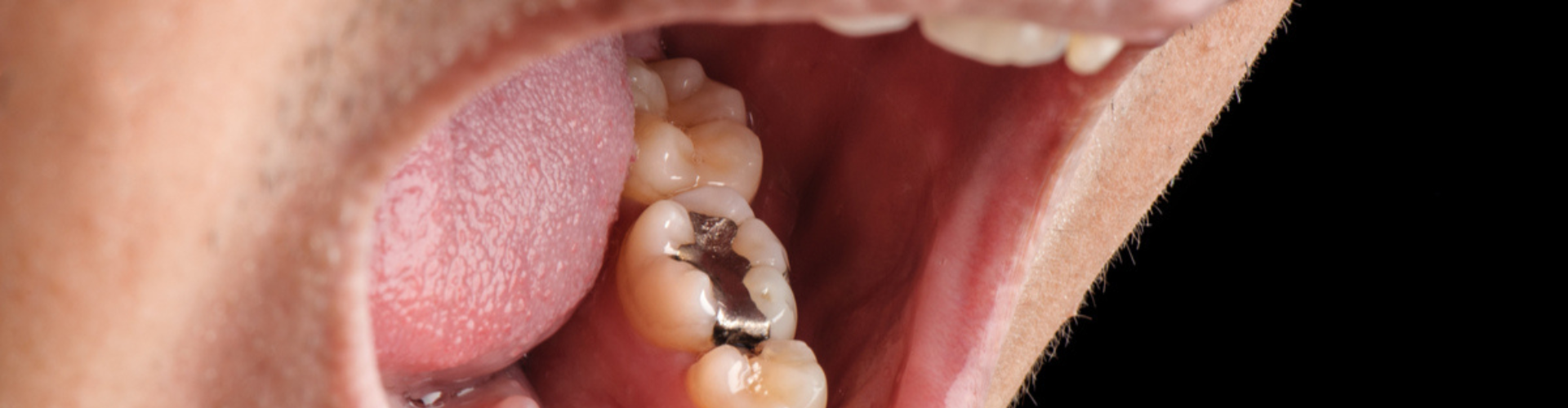 Close-up of an open mouth showing an amalgam filling in one of the molars.